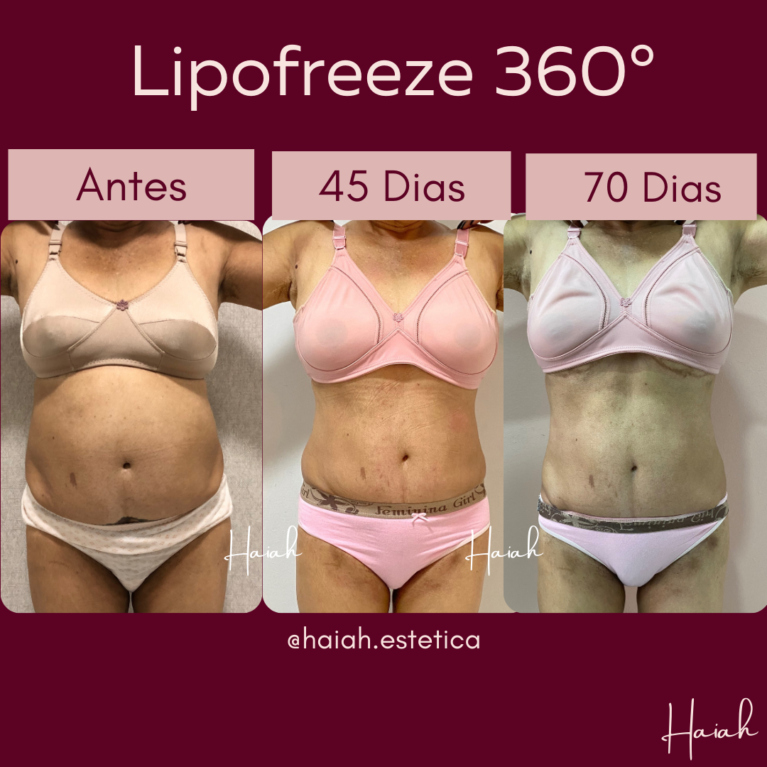 Antes e Depois HAIAH Post para Instagram - 65